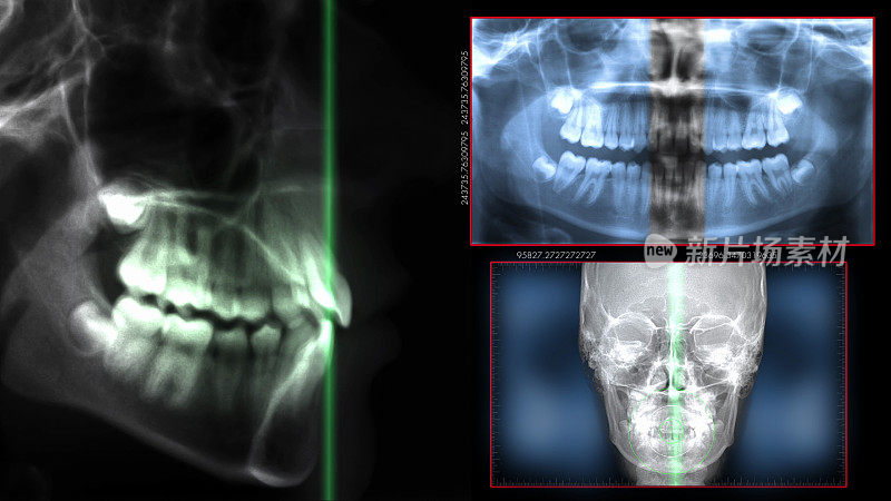牙科ct x射线数字化技术